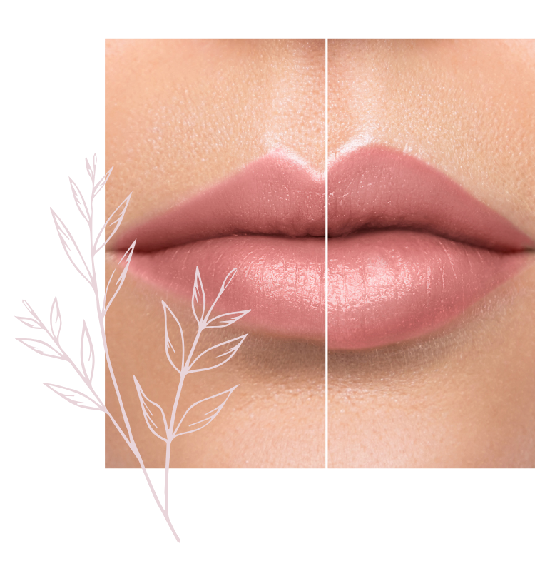 Lip Filler / Lip Augmentation