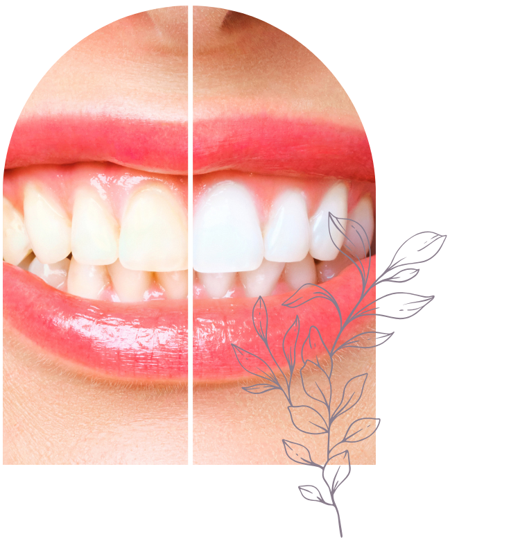 Teeth Whitening at Body Beautiful Day Spa